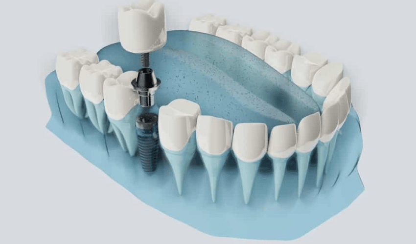 dental implants in Broken Arrow