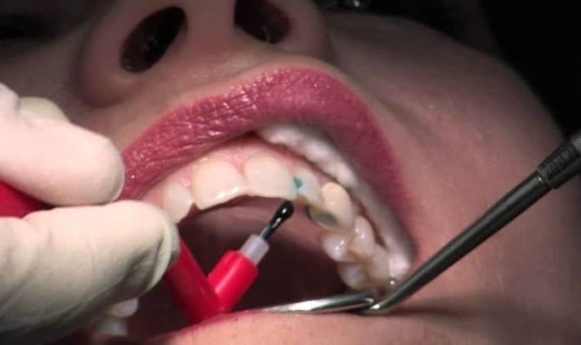Cavitie Treatment