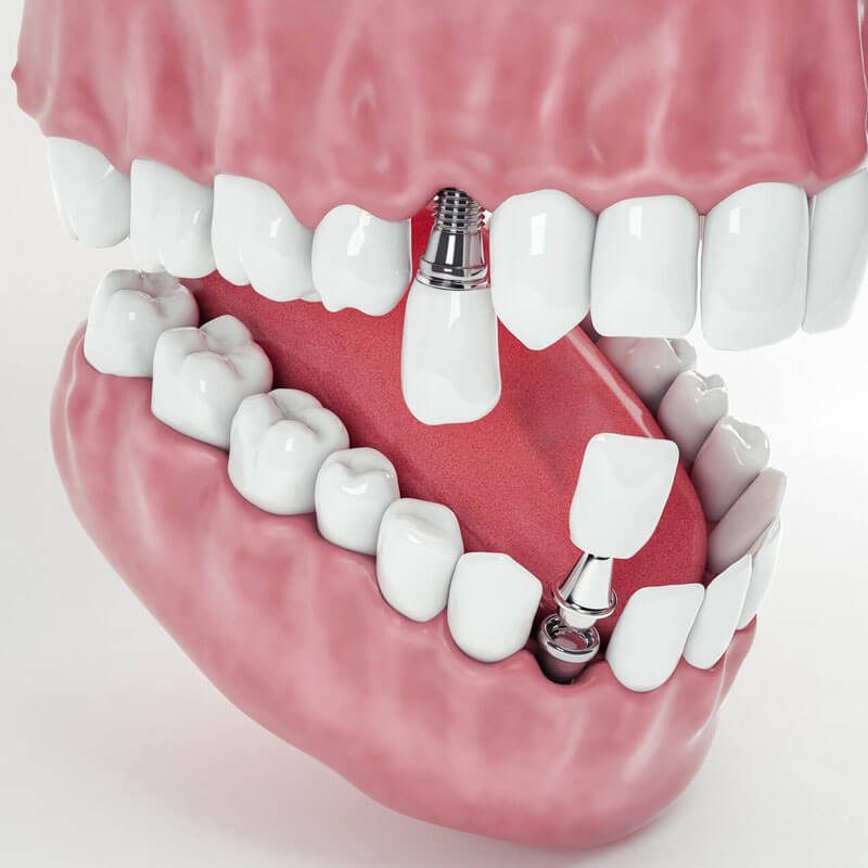 img-special-Dental-Implant-Special